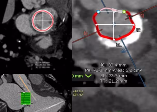 Training Professionals Across the Globe in the Latest Techniques for Cardiovascular Imaging and Transcatheter Mitral Valve Replacement