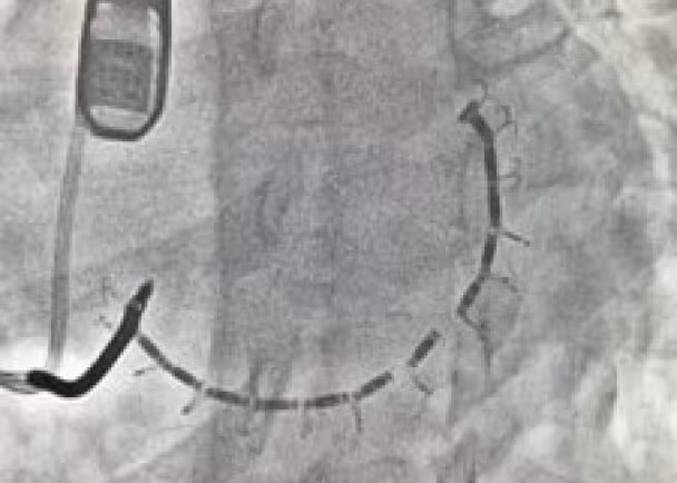 Accucinch Minneapolis Heart Institute Foundation