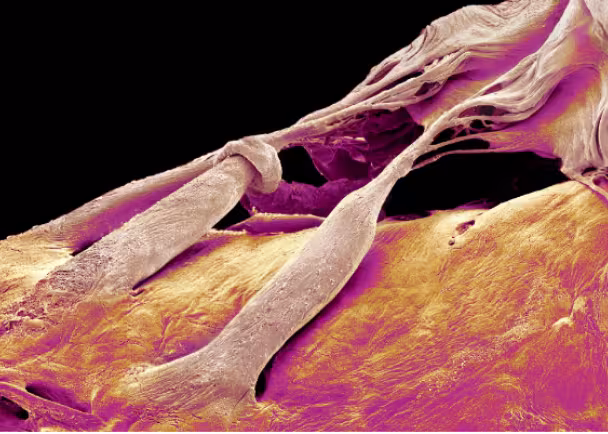 heart disease thumbnail