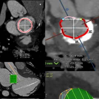 Training Professionals Across the Globe in the Latest Techniques for Cardiovascular Imaging and Transcatheter Mitral Valve Replacement