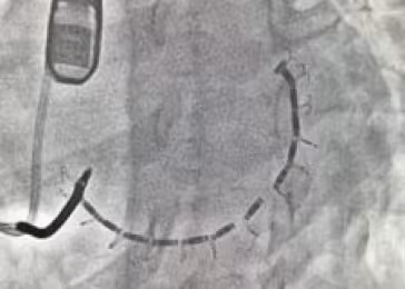 Accucinch Minneapolis Heart Institute Foundation